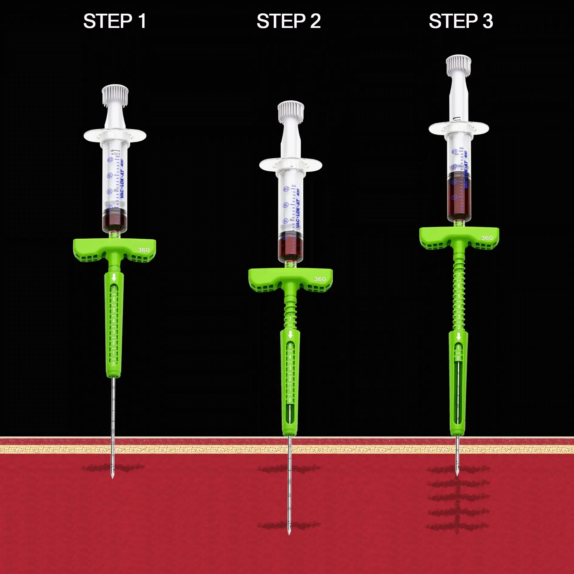 schema-aspirazione-marrow-stem
